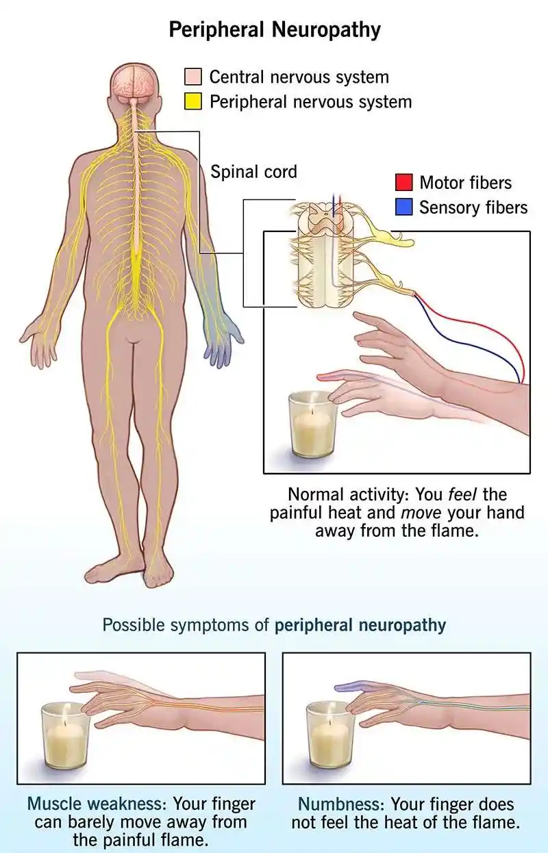 Medical illustration showing detailed symptoms of peripheral neuropathy, including numbness, tingling, burning sensation, muscle weakness, and loss of coordination in hands and feet.
