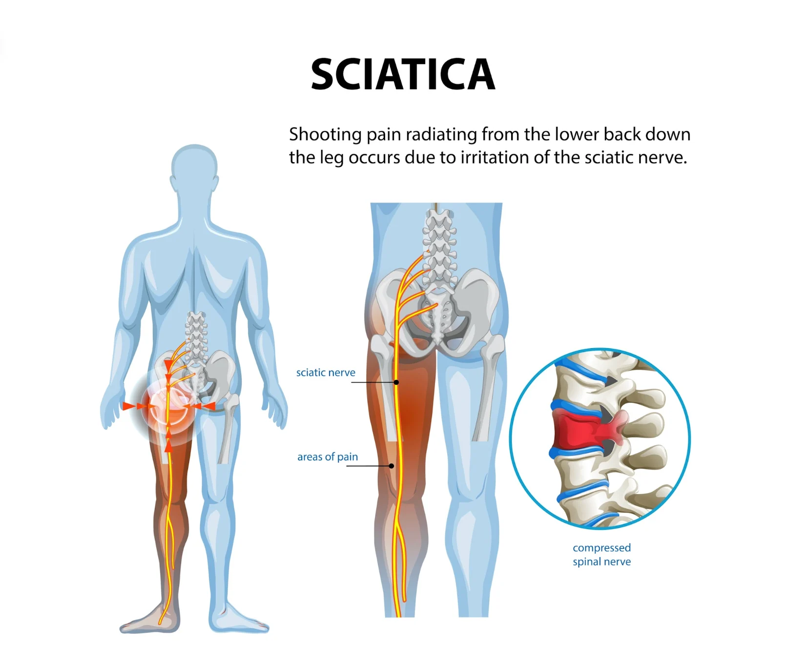 An anatomical illustration of sciatica, showing the sciatic nerve, areas of pain radiating from the lower back down the leg, and a close-up of a compressed spinal nerve.